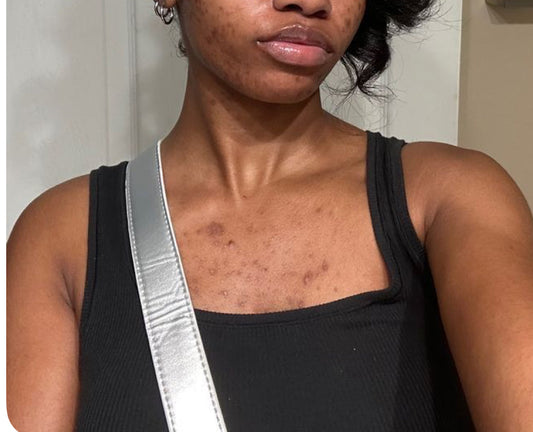5 Natural Remedies That Actually Work for Body Acne (Back, Chest & More)