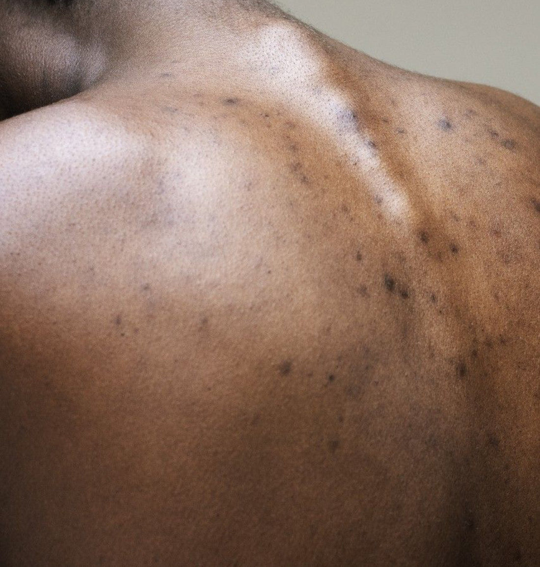 How to Get Rid of Back Acne Naturally (and Gently)