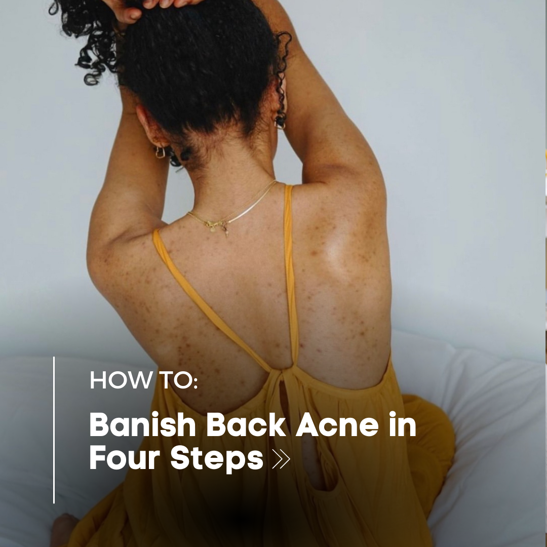 Banishing Back Acne: 4 Steps to a Clearer, Confident You