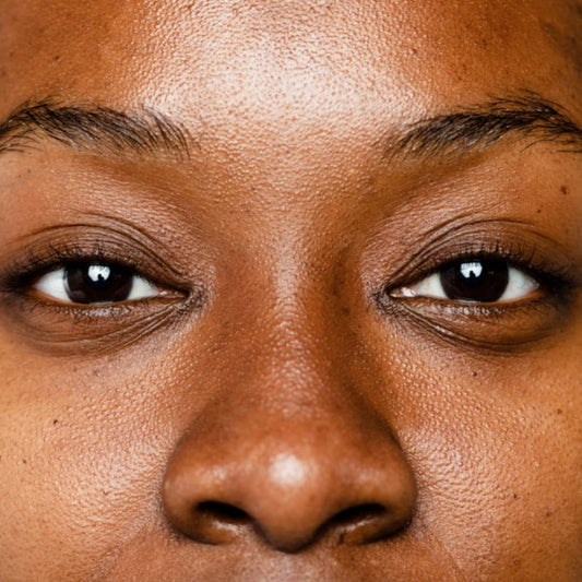 What Is Hyperpigmentation?